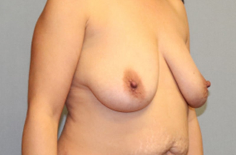 Breast Lift Before And After Photo