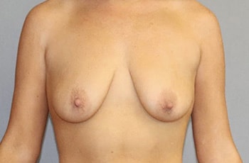 Breast Lift Before And After Photo