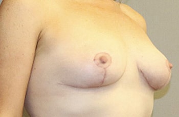 Breast Lift Before And After Photo