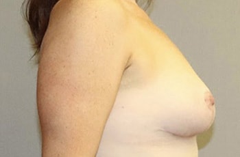 Breast Lift Before And After Photo