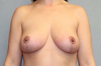 Breast Lift Before And After Patient 23