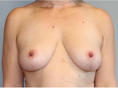 Breast Lift Before And After Photo