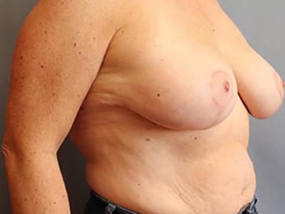 Breast Lift Before And After Photo