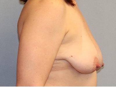 Breast Lift Before And After Photo