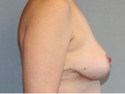 Breast Lift Before And After Photo