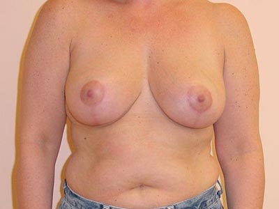 Breast Lift Before And After Photo