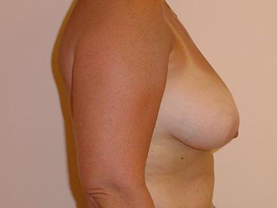 Breast Lift Before And After Photo