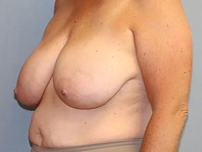 Breast Lift Before And After Photo