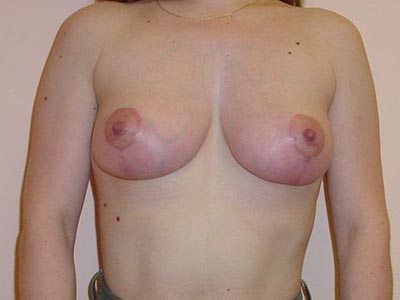 Breast Lift Before And After Photo