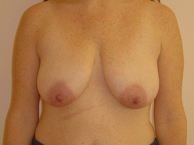 Breast Lift Before And After Photo