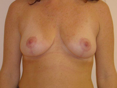 Breast Lift Before And After Patient 28