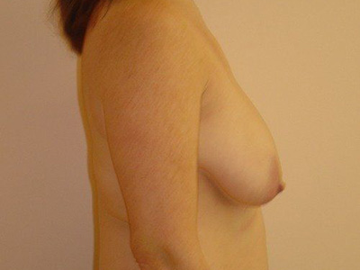 Breast Lift Before And After Photo