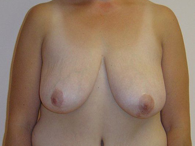 Breast Lift Before And After Photo