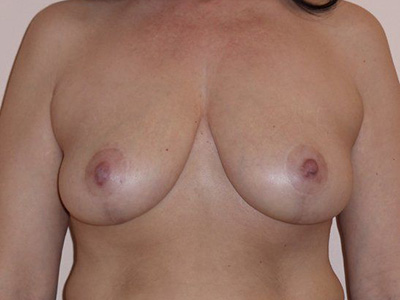 Breast Lift Before And After Patient 30