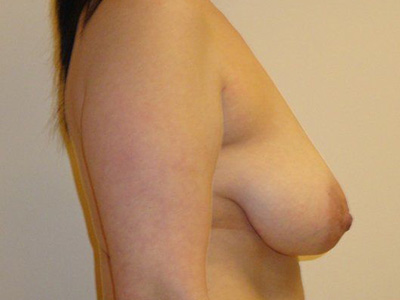 Breast Lift Before And After Photo