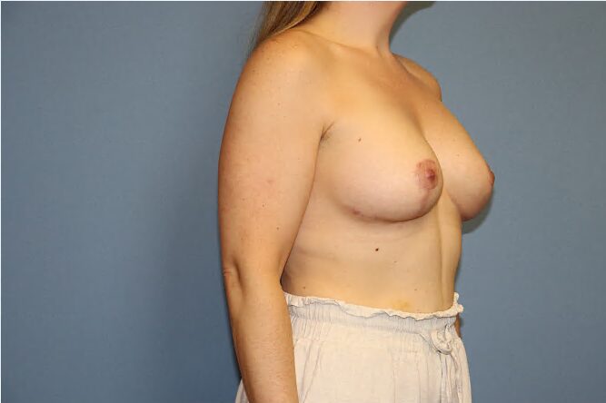 Breast Lift Before & After Image