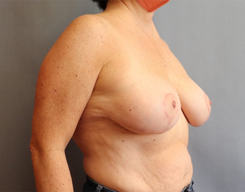 Breast Reduction Before And After Photo