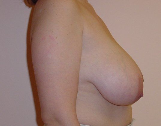 Breast Reduction Before And After Photo