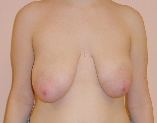 Breast Reduction Before And After Photo