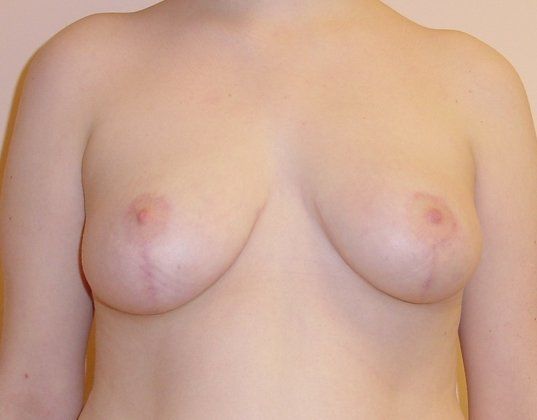 Breast Reduction Before And After Photo