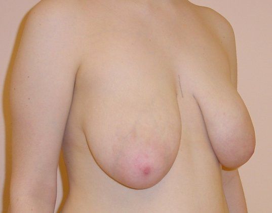 Breast Reduction Before And After Photo