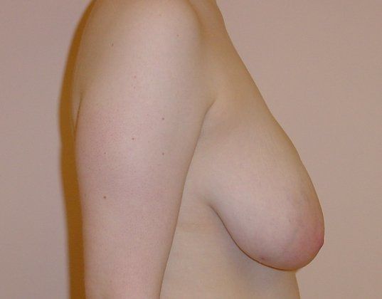 Breast Reduction Before And After Photo