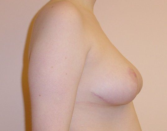 Breast Reduction Before And After Photo