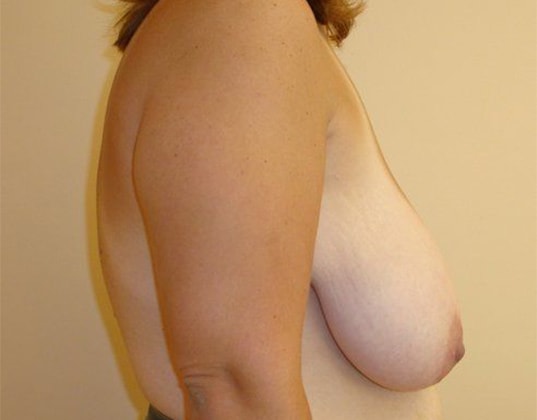 Breast Reduction Before And After Photo
