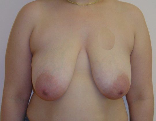 Breast Reduction Before And After Photo