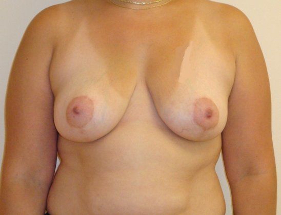 Breast Reduction Before And After Patient 5