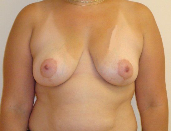 Breast Reduction Before And After Photo