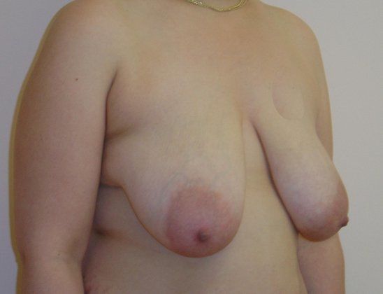 Breast Reduction Before And After Photo