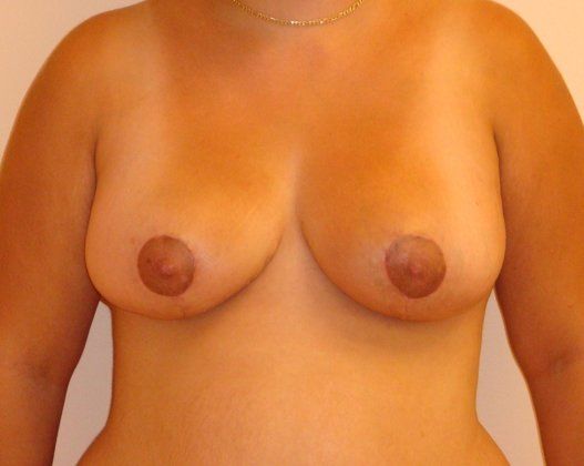 Breast Reduction Before And After Photo