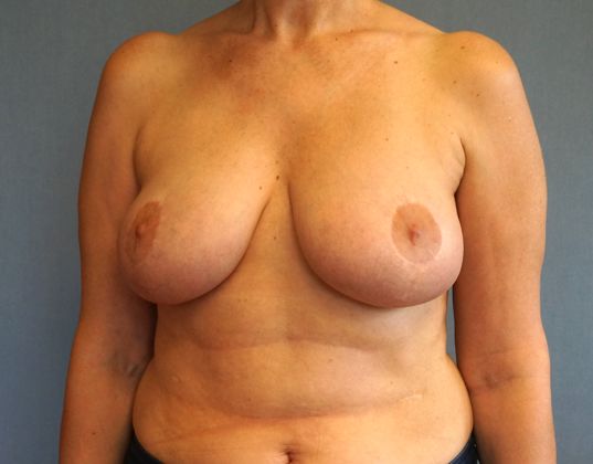 Breast Reduction Before And After Photo