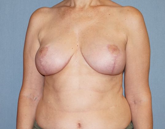 Breast Reduction Before And After Photo