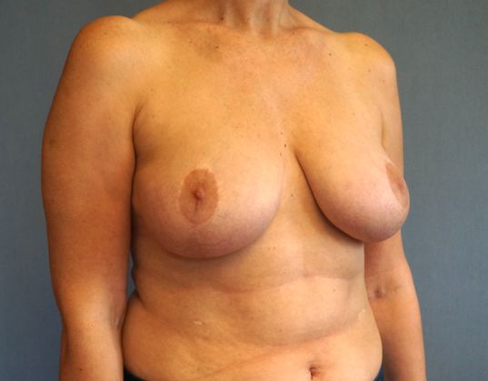 Breast Reduction Before And After Photo