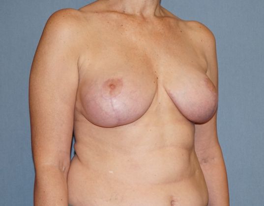 Breast Reduction Before And After Photo