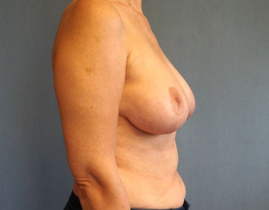 Breast Reduction Before And After Photo