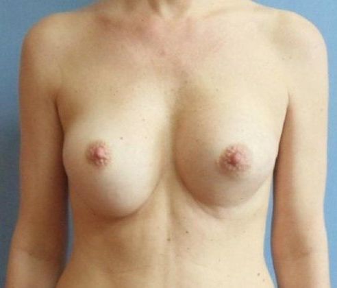 Breast Revision & Asymmetry Before And After Photo