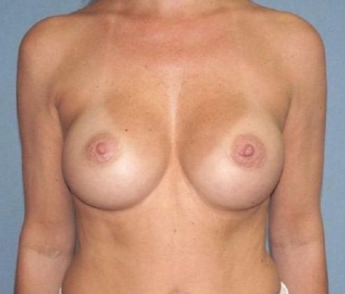 Breast Revision & Asymmetry Before And After Patient 1