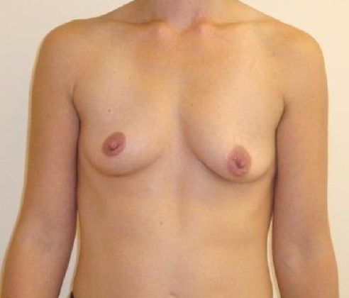 Breast Revision & Asymmetry Before And After Photo