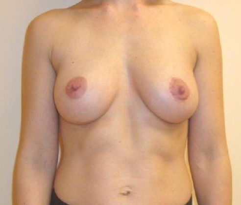 Breast Revision & Asymmetry Before And After Patient 2