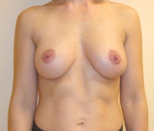 Breast Revision & Asymmetry Before And After Photo