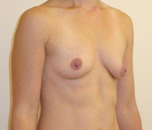 Breast Revision & Asymmetry Before And After Photo