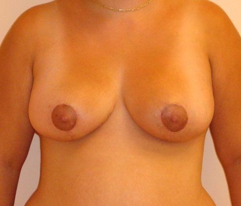 Breast Revision & Asymmetry Before And After Patient 5