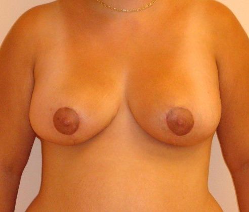 Breast Revision & Asymmetry Before And After Photo