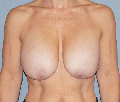 Breast Revision & Asymmetry Before & After Image