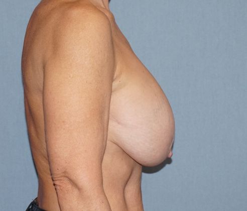 Breast Revision & Asymmetry Before And After Photo