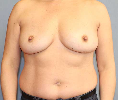 Breast Revision & Asymmetry Before And After Patient 7