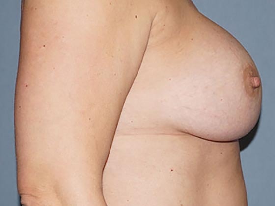 Breast Revision & Asymmetry Before And After Photo